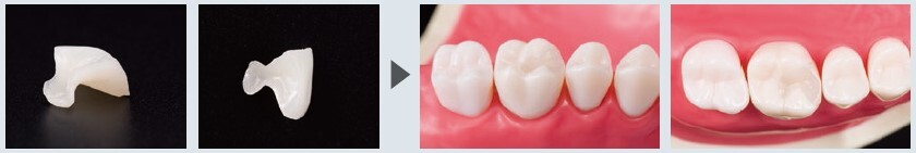 高強度ハイブリッド型硬質レジン