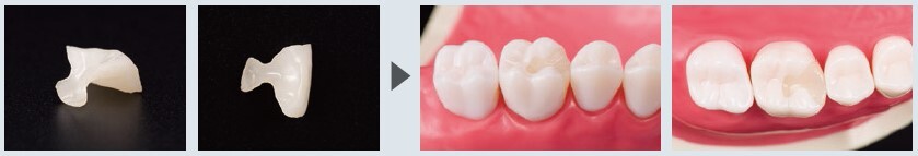 オールセラミックス